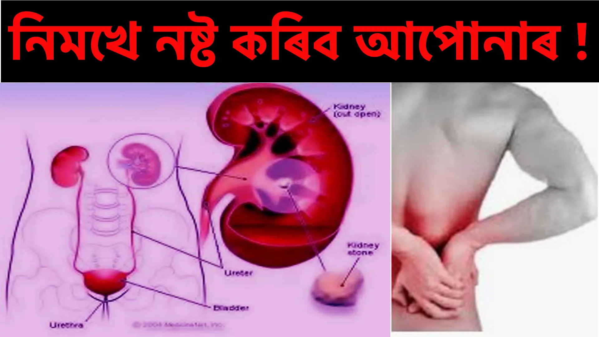 লিমখে-নষ্ট-কৰিব-আপোনাৰ-কিডনি